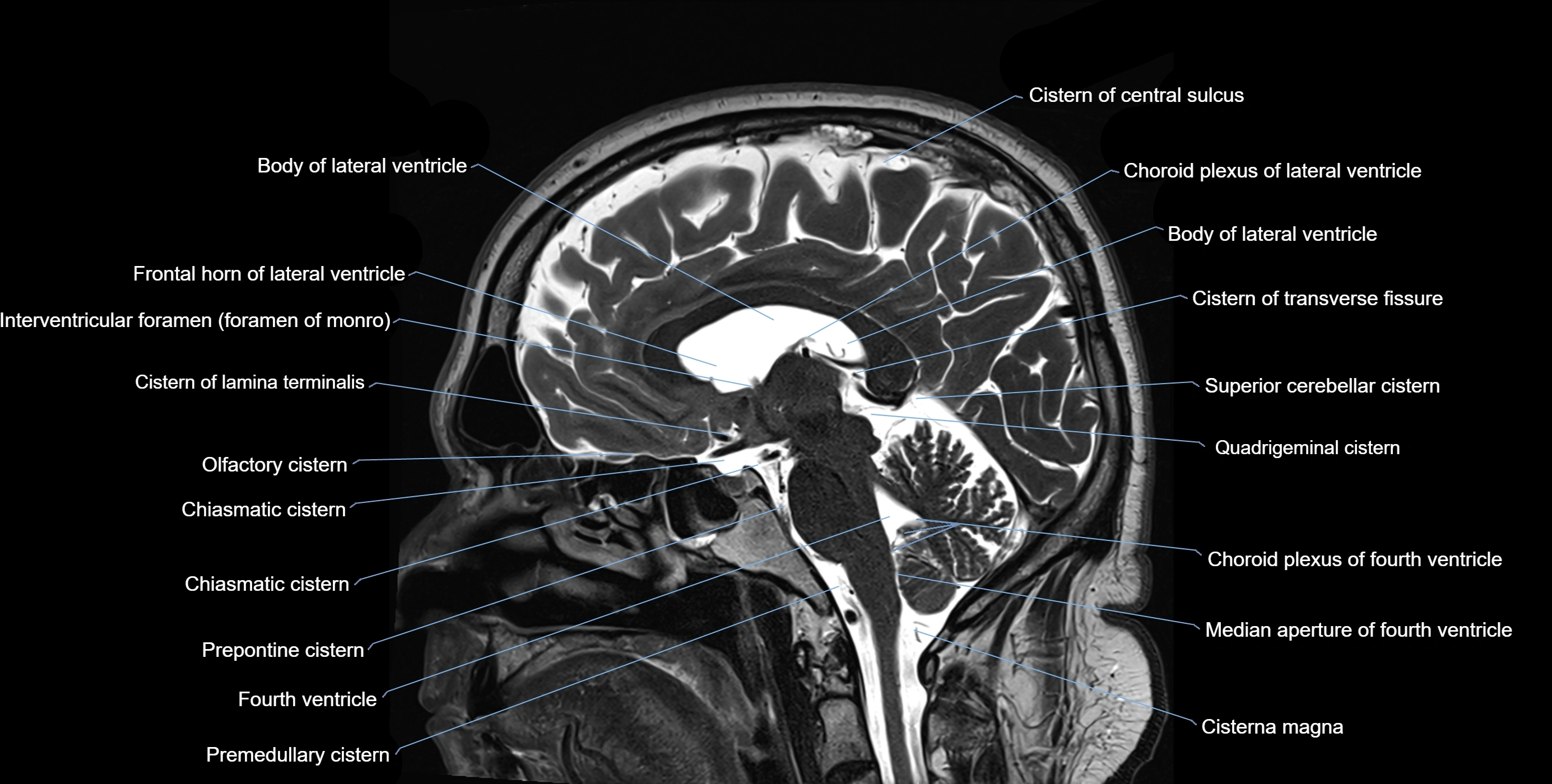 Brain cisterns  and ventricles sagittal anatomy 3T MRI image-img-00001-00031.webp